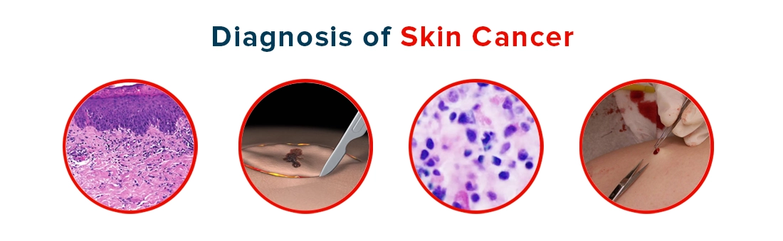 Diagnosis of Skin Cancer